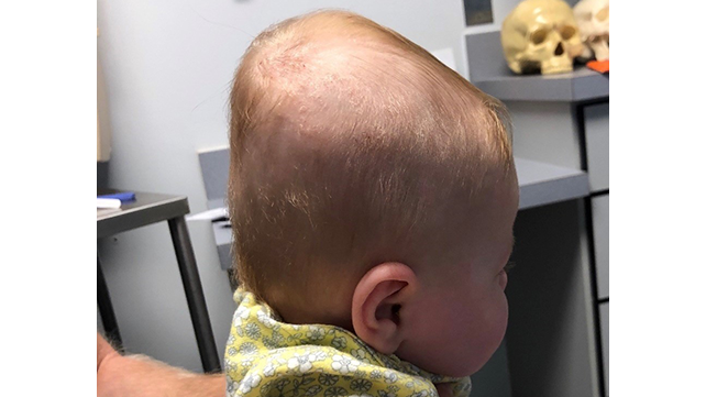 Deformational Plagiocephaly (Flat Head Syndrome) 
