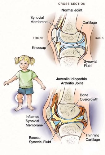 Juvenile Arthritis