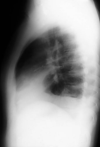 pleural effusion 