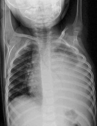 loculated effusion