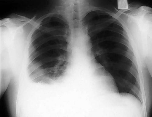 pleural effusion