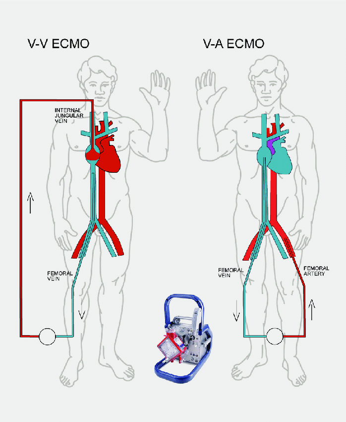 ECMO 