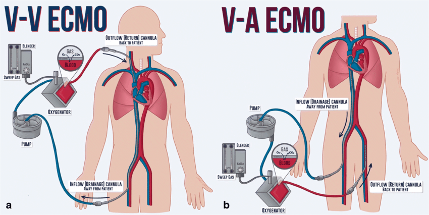 ECMO 